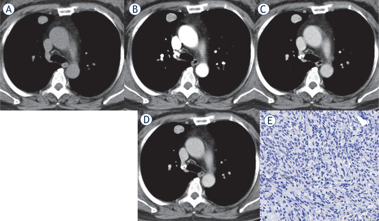 Multi-phase contrast-enhanced CT of peripheral PSP with lower Ki-67 index. Axial unenhanced CT image revealed a peripheral isodense nodule in the right upper lobe with a CT density of 46 Hu (A). After administration of the contrast medium, the lesions showed homogeneous enhancement. The lesion showed progressive and continuous enhancement in the arterial phase (73 Hu) (B) and venous phase (102 Hu) (C), with a certain enhancement washout in the delayed phase (87 Hu) (D). Immunohistochemical staining showed the Ki-67 reactive tumor cells accounted for about 1% (× 400) (E).