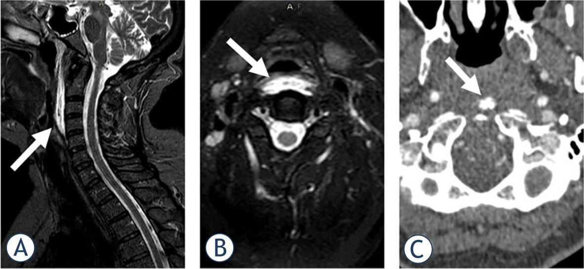 STIR (short tau inversion recovery) imaging in sagittal (A) and axial (B) plane demonstrated prevertebral soft tissue swelling and oedema in a 51-year-old female, suggesting retropharyngeal calcific tendinitis as the underlying cause. Calcifications in the medial aspect of the longus colli muscle in front of the C1 arc were noted on computed tomography angiography (CTA) (C), confirming the diagnosis.