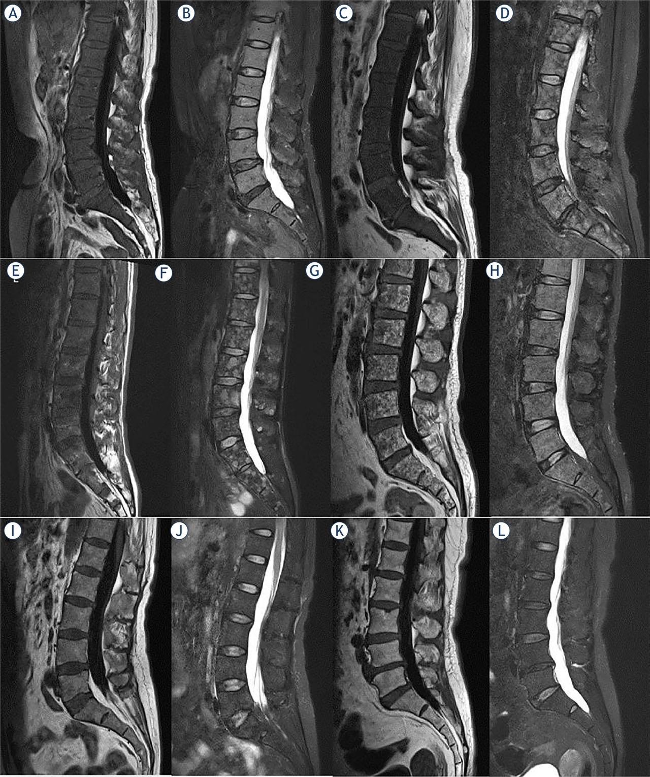 Five bone marrow infiltration patterns of multiple myeloma patients and healthy controls: pure diffuse pattern (A, B), combined diffuse/focal pattern (C, D), focal pattern (E, F), salt and pepper pattern (G, H), normal pattern (I, J), healthy control (K, L). T1 weighted(WI) image (A, C, E, G, I, K), T2WI FS image (B, D, F, H, J, L).
