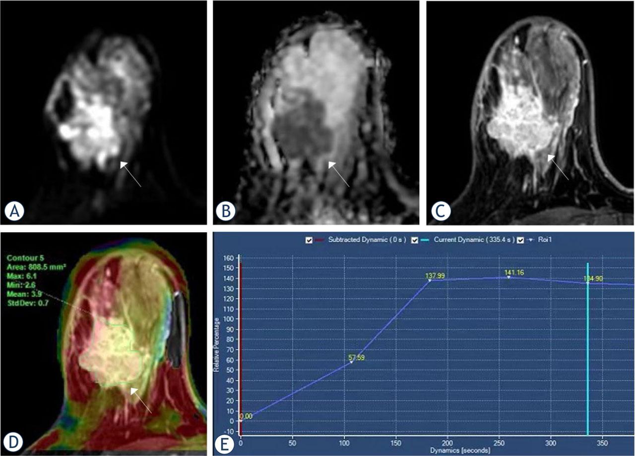 Magnetic resonance imaging (MRI) from a 42-year-old woman with invasive breast carcinoma. (A) DWI = diffusion-weighted imaging (B) apparent diffusion coefficient (ADC) (C) dynamic contrast-enhanced (DCE) (D) The amide proton transfer-weighted imaging (APTWI) pseudo-color image was merged with the DCE images and the APT value was 3.9%. (E) The type of time-intensity curves (TIC) was plateau.