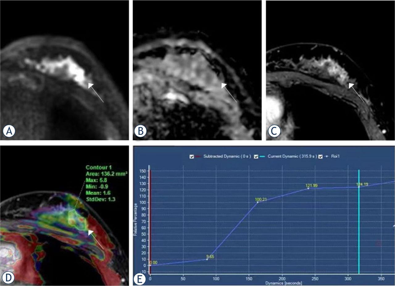 Magnetic resonance imaging (MRI) from a 26-year-old woman with intraductal papilloma. (A) Diffusion-weighted imaging (DWI); (B) apparent diffusion coefficient (ADC); (C) dynamic contrast-enhanced (DCE); (D) the amide proton transfer-weighted imaging (APTWI) pseudo-color image was merged with the DCE images and the APT value was 1.6%; (E) the type of time-intensity curves (TIC) was persistent.