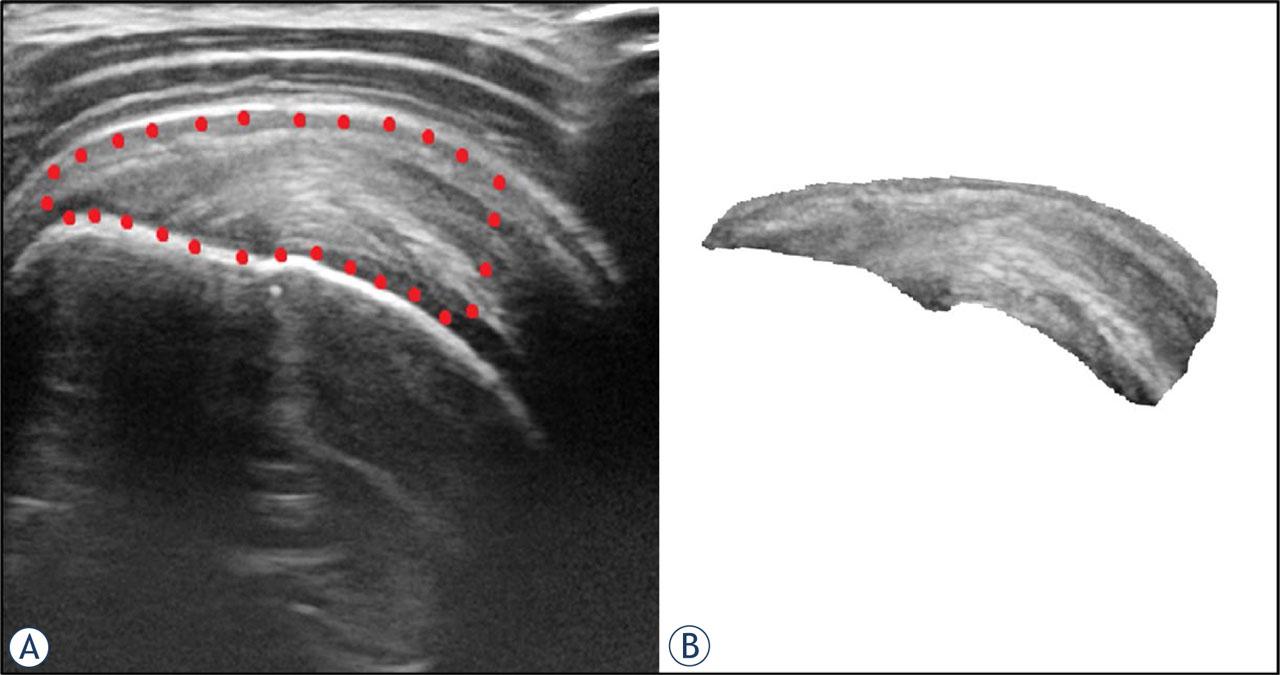 US image of the representative supraspinatus tendinosis in longitudinal plane (A). Region of interest was selected from the footprint of the tendon to the myotendinous junction of supraspinatus muscle (encircled with red dots) and cropped for the purpose of texture analysis (B).