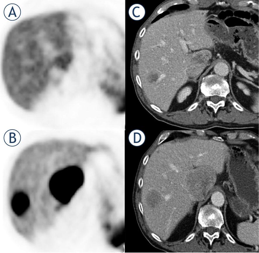 72-year-old male with responding liver metastases of pancreatic neuroendocrine tumor. on the pretherapeutic PET/CT (A, B) there were high tumor-to-liver (t/l) ratios. after three months of treatment with CAPTEM, both liver metastases showed a shrinkage in size, but also a significantly reduced uptake of 68ga-dotatate compared to pretherapeutic PET/ CT (C, D).CAPTEM = capecitabine and temozolomide
