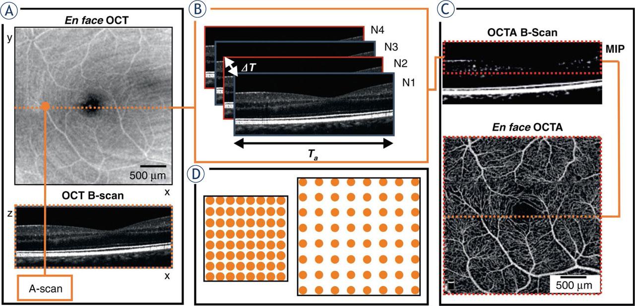 Optical coherence angiography (OCTA) scanning protocol. (A) A raster scanning protocol for blood vessel visualization, with the x-axis sampling density determined by A-scans per B-scan sets and the y-axis determined by B scans per volume sets. (B) OCTA B-scans created by four repeated B-scans at one y-location, repeated for varying positions along the y-axis, impacting sampling density; ΔT represents interscan time and Ta denotes acquisition time. (C) Maximum intensity projection (MIP) applied to the OCTA B-scan within the depth range of interest (where vessels are located) to generate one line of the en face OCTA image. (D) Illustration depicting the equal distribution of sampling points for smaller and larger imaging areas. Taken from Sampson et al.12 and reprinted with permission from the publisher by the Creative Commons license. To view a copy of Creative Commons license, visit http://creativecommons.org/licenses/by/4.0/.