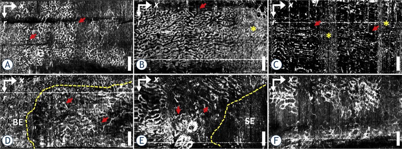 Images obtained through optical coherence tomography angiography (OCTA) for (TOP ROW) nondysplastic Barrett's esophagus (NDBE) and (BOTTOM ROW) low-grade/high-grade dysplasia (LGD/HGD) (bottom left LGD; bottom center and bottom right HGD). NDBE images show a regular honeycomb microvascular pattern (arrows, top row), while abnormal vascular features, such as abnormal vessel branching (arrows, bottom left), heterogeneous vessel size (arrows, bottom center) or both (bottom right), are observed in LGD/HGD. Motion artifacts are denoted by asterisks. OCTA images can assist in distinguishing the boundary between abnormal microvasculature and neighboring nondysplastic regions (dashed line, bottom left and bottom center). Taken from Lee et al.16 and reprinted with permission from the publisher.