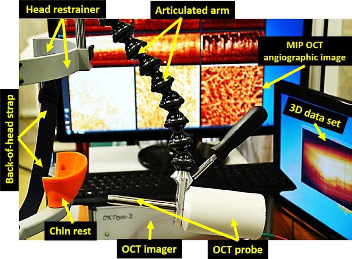 Optical coherence tomography angiography (OCTA) acquisition system. OCTA images were acquired in real time. Taken from Maslennikova et al.17 and reprinted with permission from the publisher by the Creative Commons license. To view a copy of Creative Commons license, visit http://creativecommons.org/licenses/by/4.0/.