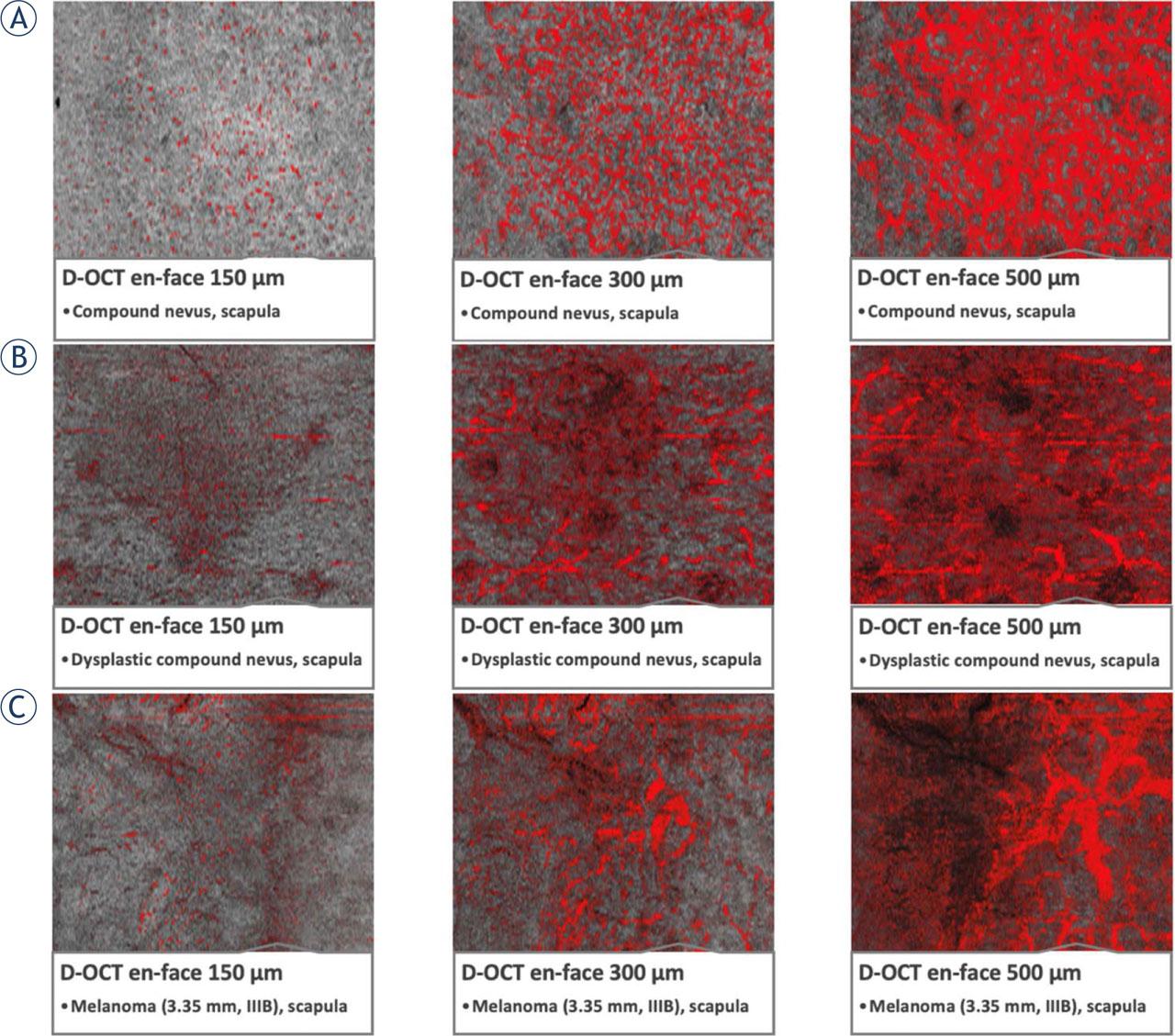 Microvascularization in skin lesions (nevi, dysplastic nevi, and melanomas) through optical coherence tomography angiography (OCTA) scans (denoted as D-OCT). (A) Compound nevus on the scapula, displaying a globular appearance with recent changes. (B) Dysplastic nevus, flat lesion on the scapula, exhibiting a complex appearance, atypical network, irregular pigmentation, and dots/globules. (C) Melanoma, a lesion on the scapula, measuring 3.35 mm in tumor thickness, classified as pT3aN1bM0S2, stage IIIB. Taken from Perwein et al.25 and reprinted with permission from the publisher by the Creative Commons license. To view a copy of Creative Commons license, visit http://creativecommons.org/licenses/by/4.0/.