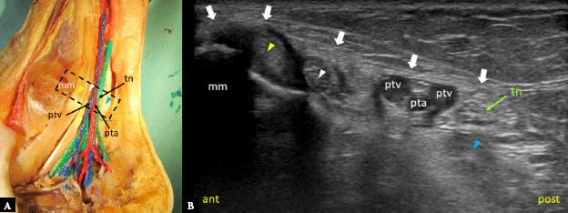An anatomic section of the tarsal tunnel (A) and an axial ultrasound image showing the proximal tarsal tunnel (B). Dashed rectangle indicates probe placement. Anterior (ant) indicates the anterior part of the tarsal tunnel, and posterior (post) the posterior part. Tibial nerve (tn), posterior tibial artery (pta), posterior tibial veins (ptv), tibialis posterior tendon (yellow arrowhead), flexor digitorum longus tendon (white arrowhead), flexor hallucis longus tendon (blue arrowhead), medial malleolus (mm), flexor retinaculum (thick white arrows)