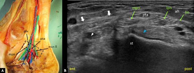 An anatomic section of the tarsal tunnel (A) and an axial ultrasound image showing the distal tarsal tunnel above the level of posterior tibial artery bifurcation (B). Dashed rectangle indicates probe placement. Anterior (ant) indicates the anterior part of the tarsal tunnel, and posterior (post) indicates the posterior part. Medial plantar nerve (mpn), lateral plantar nerve (lpn), Baxter’s nerve (bn), posterior tibial artery (pta), posterior tibial vein (ptv), calcaneal nerve second branch (mcn ll). Flexor digitorum longus tendon (white arrowhead), flexor hallucis longus tendon (blue arrowhead), flexor retinaculum (thick white arrows), sustentaculum tali (st), abductor hallucis muscle (ah). On Fig. 2 A, MPN and LPN run anterior to PTA. On Fig. 2 B, PTA runs between MPN and LPN