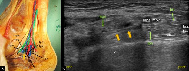 An anatomic section of the tarsal tunnel (A) and an axial ultrasound image showing the distal tarsal tunnel below the level of posterior tibial artery bifurcation (B). Dashed rectangle indicates probe placement. Anterior (ant) indicates the anterior part of the tarsal tunnel, and posterior (post) the posterior part. Medial septum (thick orange arrow), medial plantar nerve (mpn), lateral plantar nerve (lpn), Baxter’s nerve (bn), medial plantar artery and veins (mpa, mpv), lateral plantar artery and veins (lpa, lpv). Quadratus plantae muscle (qp), calcaneus (c). On Fig. 3 A, the Baxter’s nerve runs posteroinferior to LPA and LPV and anterosuperior on Fig. 3 B