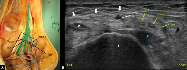 Anatomic section of the tibial nerve and its branches (A) and an axial ultrasound image showing the tarsal tunnel at the level of Baxter’s nerve branching point (B). Dashed rectangle indicates probe placement. Anterior (ant) indicates the anterior part of the tarsal tunnel, and posterior (post) indicates the posterior part. Baxter’s nerve (bn) branched off lateral plantar nerve (lpn) just below the level of tibial nerve (tn) bifurcation. Baxter’s nerve (bn), medial plantar nerve (mpn), lateral plantar nerve (lpn), posterior tibial artery (pta). Flexor digitorum longus tendon (white arrowhead), flexor hallucis longus tendon (blue arrowhead), flexor retinaculum (thick white arrows), talus (t). Tibial nerve (tn), medial calcaneal nerve first branch (mcn l), medial calcaneal nerve second branch (mcn ll)
