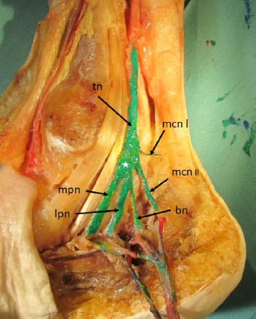 An anatomic section of the tibial nerve and its terminal branches. Neural structures are coloured green. Vascular structures are removed for better visualization. Tibial nerve (tn), medial calcaneal nerve first branch (mcn l), medial calcaneal nerve second branch (mcn ll), medial plantar nerve (mpn), lateral plantar nerve (lpn), Baxter’s nerve (bn), tibial nerve division site (white asterisk)