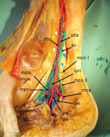 An anatomic section of the tarsal tunnel. Neural structures are coloured green; arteries are coloured red; veins are coloured blue. Tibial nerve (tn), posterior tibial artery (pta), posterior tibial vein (ptv), medial calcaneal nerve first branch (mcn l), medial calcaneal nerve second branch (mcn ll), medial plantar nerve (mpn), lateral plantar nerve (lpn), Baxters nerve (bn), medial plantar artery and medial plantar veins (mpa, mpv), lateral plantar artery and lateral plantar veins (lpa, lpv), medial calcaneal artery (mca), tibialis posterior tendon (yellow arrowhead), flexor digitorum longus tendon (white arrowhead), flexor hallucis longus tendon (blue arrowhead), medial intermuscular septum (thick yellow arrow), medial malleolus (mm), abductor hallucis muscle (ah)