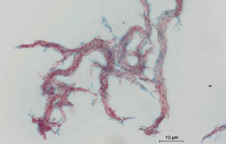 Mycobacterium abscessus subsp. abscessus. Photography of smear stained by Ziehl-Neelsen method for acid-fast bacilli (AFB). Counterstaining creates a compelling visual contrast of red acid-fast bacilli.