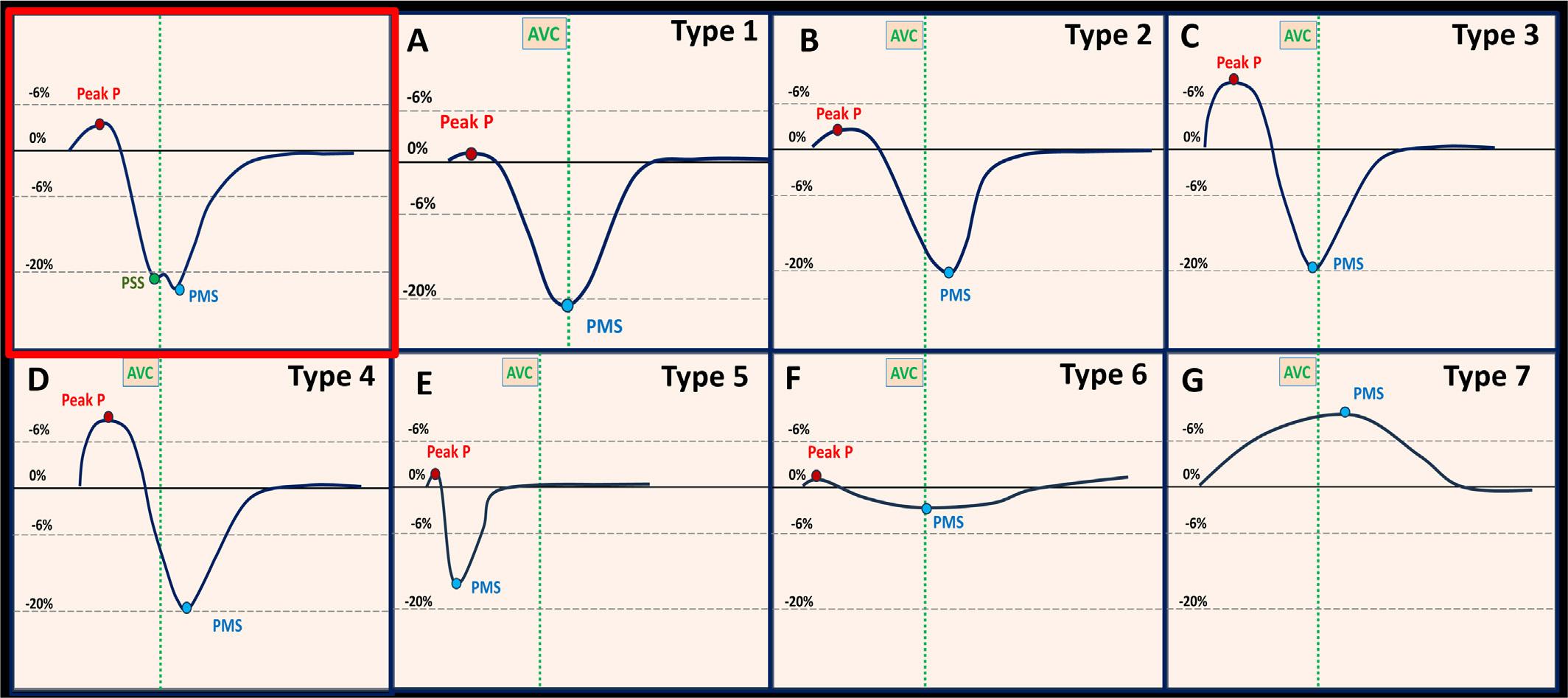 Red quadrant: longitudinal strain curve showing all components: Peak P as initial lengthening; PSS: peak systolic strain as the maximum longitudinal deformation before aortic valve closure (AVC); PMS: peak maximum strain as the maximum longitudinal deformation during the cardiac cycle. A) Type 1 curve; B) Type 2 curve; C) Type 3 curve; D) Type 4 curve; E) Type 5 curve; F) Type 6 curve; G) Type 7 curve.