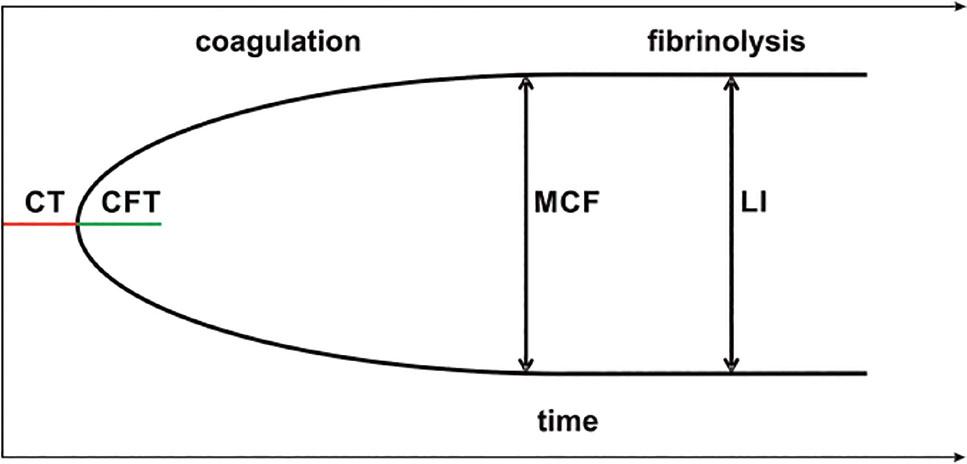 Thromboelastometry (ROTEM®) diagram. CT – represents time from the start of the test until the initiation of clotting; CFT – represents time from the initiation of clotting until a clot firmness of 20 mm was detected; MCF – represents the overall strength of the clot by the polymerized fibrin, thrombocytes, and factor XIII. LI – represents clot stability and a reduction in clot firmness after MCF. CFT, clot formation time; CT, clotting time; LI, lysis index; MCF, maximum clot firmness.
