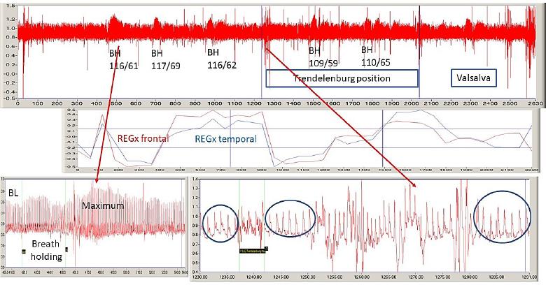 Trace of bifrontal REG (upper trace) on a tilting table. BH indicates the breath holdings. Under its label are the blood pressure (systolic/diastolic) numbers. The middle traces are the REGx traces. The lower trace shows fragments of REG during breath-holding (left side) and transition from horizontal to HDT position (right side). Arrows indicate the location of magnified portions. The Y-axis is in Volt. The X-axis is in seconds. The window size is 2630 seconds, 43.83 min. The file name is April 26 1.