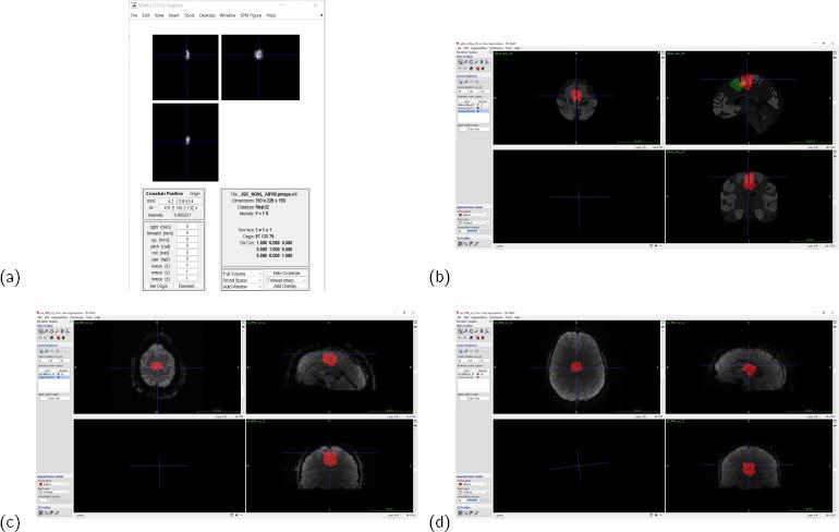 Examples from the ROI extraction and later adaptation. (a) SMA in the right hemisphere as directly shown through the SPM display code shown earlier; (b) the combined SMA in MNI space shown in green, and SMA realigned according to the pre-fMRI volume of a person having gone through the SPM adaptation algorithm (in red), the required shift according to fMRI-space is evident; (c) the same shifted ROI from (b) shown according to the fMRI volume of the person to be trained; (d) the same ROI from (b-c) overlaid the pre-fMRI of a different person having gone through the rtfMRI-nf, the need for realignment is evident.