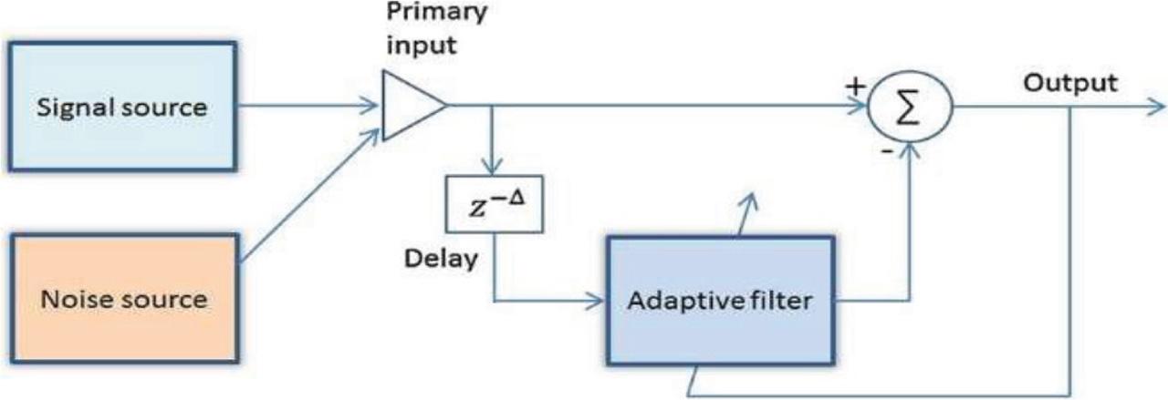 Block diagram of ALE. ALE, adaptive line enhancer.