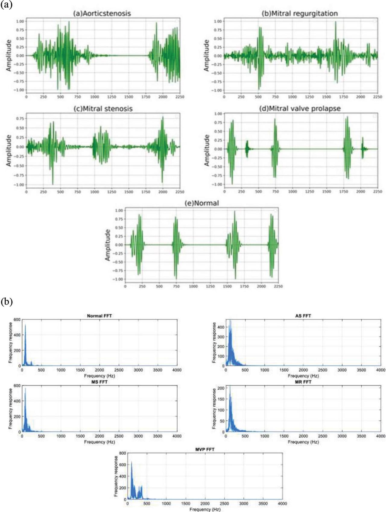 Time (a) and frequency (b)-domain analysis of different PCG signals using DWT. AS, aortic stenosis; DWT, discrete wavelet transform; MR, mitral regurgitation; MS, mitral stenosis; MVP, mitral valve prolapse; PCG, phonocardiogram.