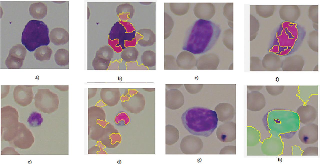 (a, c, e, g) Original dataset images; and (b, d, f, h) LIME interpretation results. LIME, Local Interpretable Model-Agnostic Explanations.