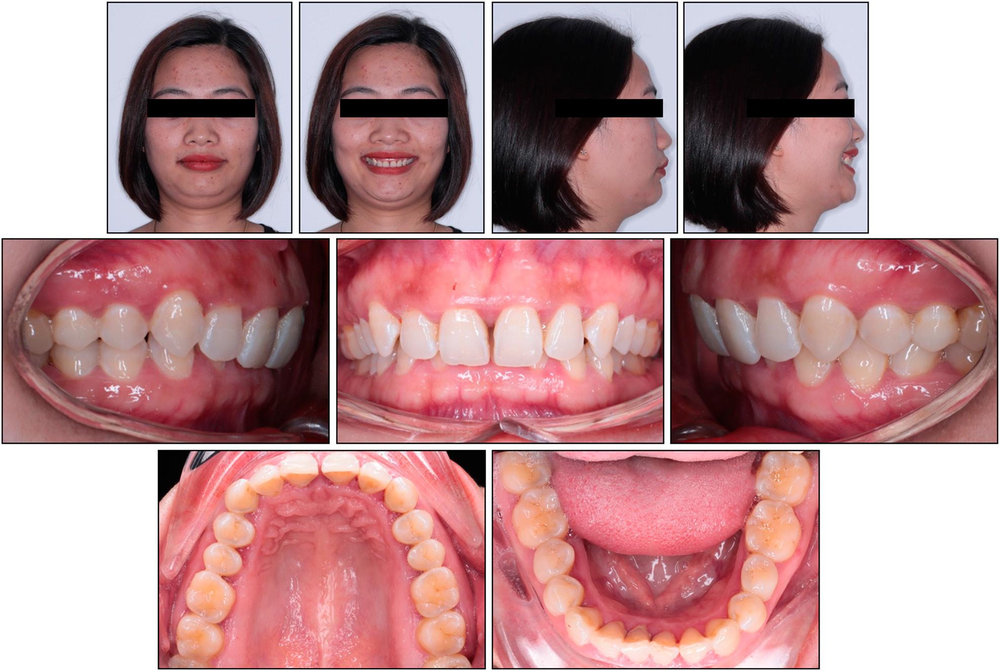 Case 1: initial extraoral and intraoral photographs.