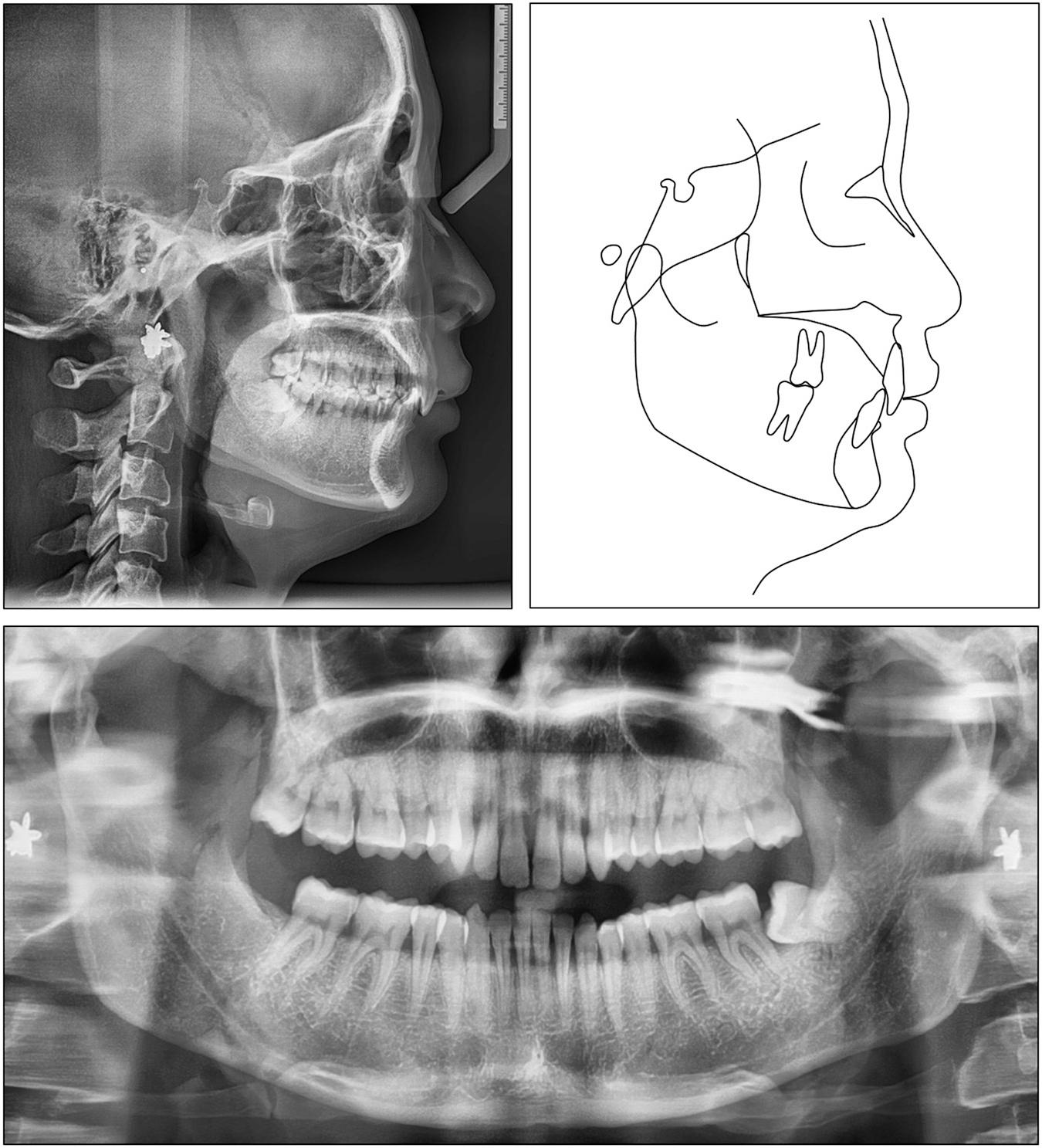 Case 1: initial panoramic and cephalometric radiographs and tracing.