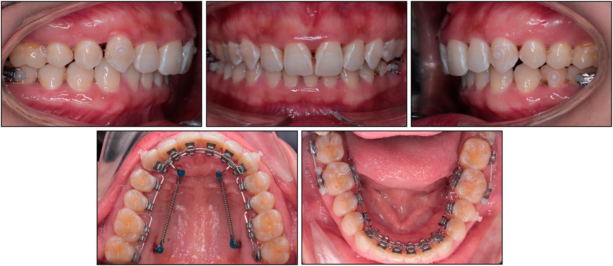 Entire upper arch distalisation using mini-screws, crimpable hooks, and coil springs.