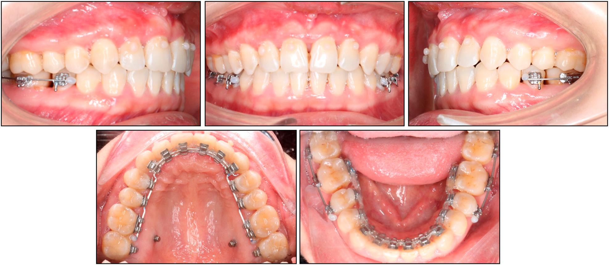Finishing and detailing stage. Gingival black triangles before interproximal stripping.