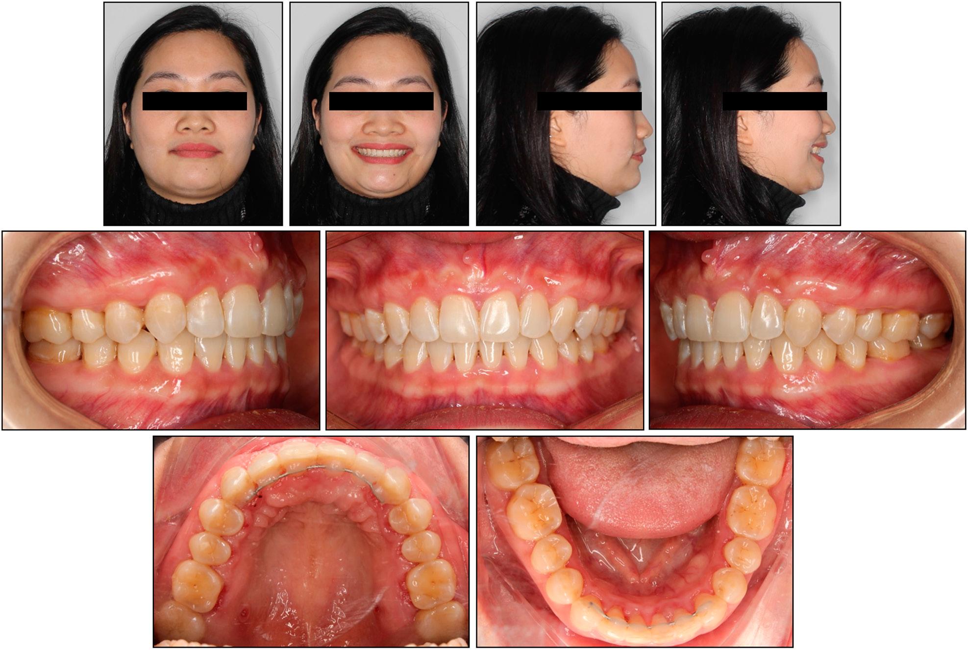 Case 1: post-treatment extraoral and intraoral photographs.