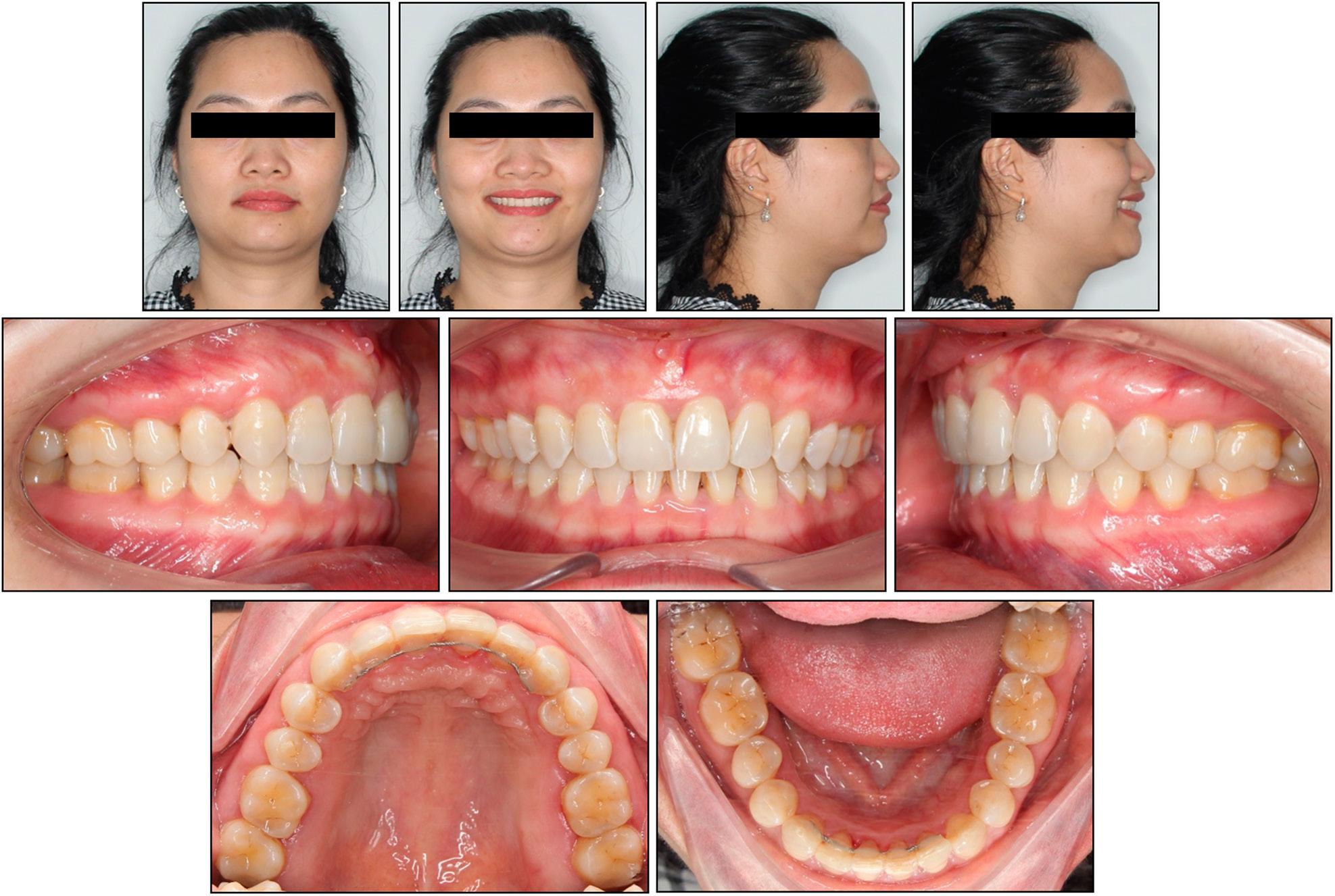 Case 1: two-year post-retention extraoral and intraoral photographs.