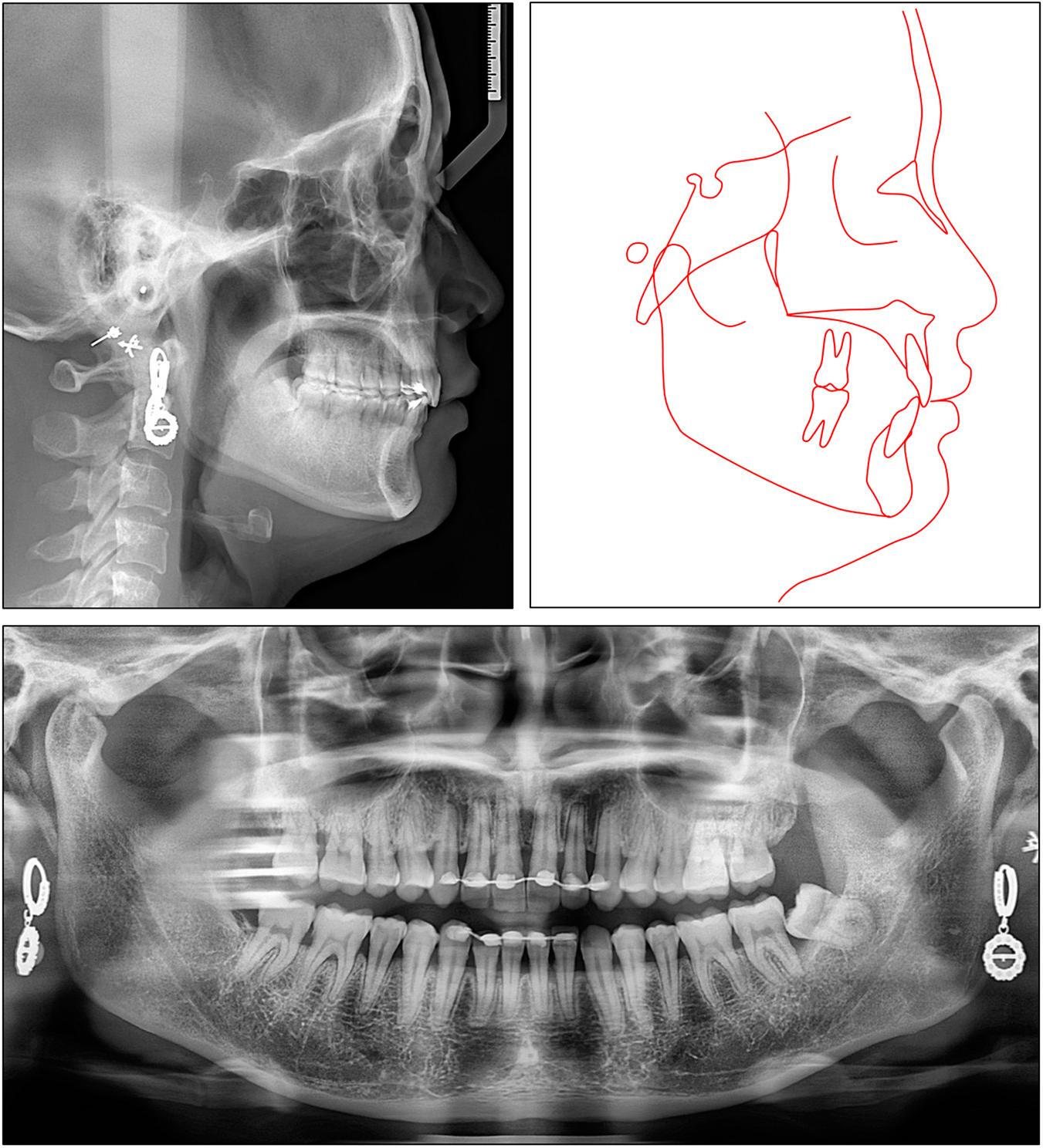 Case 1: post-retention panoramic and cephalometric radiographs and tracing.