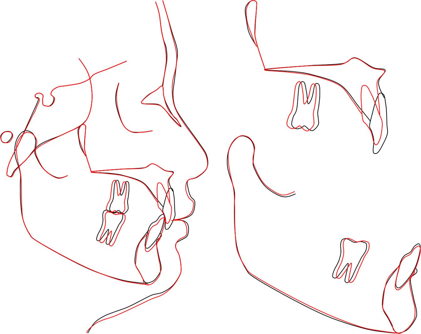 Case 1: general and regional superimpositions of pretreatment and post-retention cephalometric tracings.