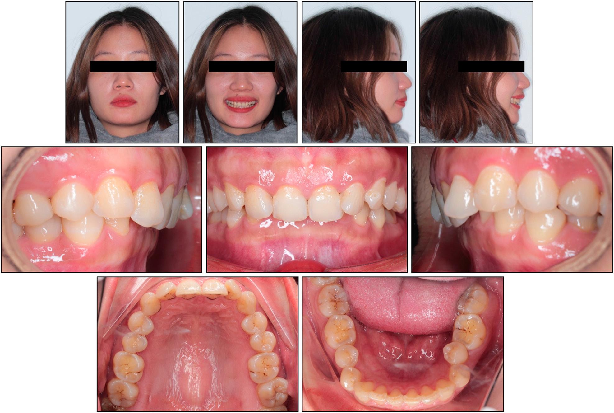 Case 2: initial extraoral and intraoral photographs.