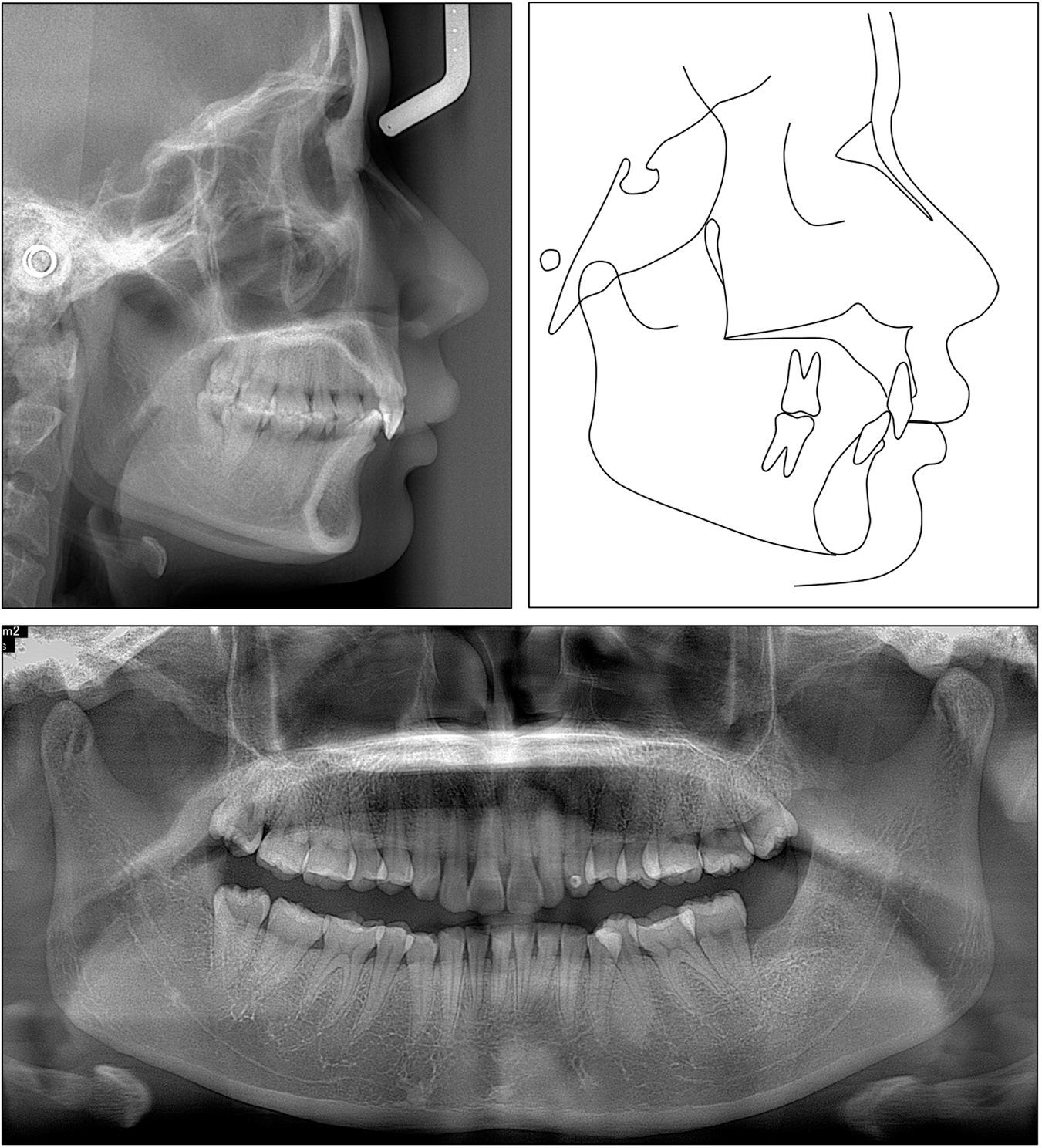 Case 2: initial panoramic and cephalometric radiographs and tracing.