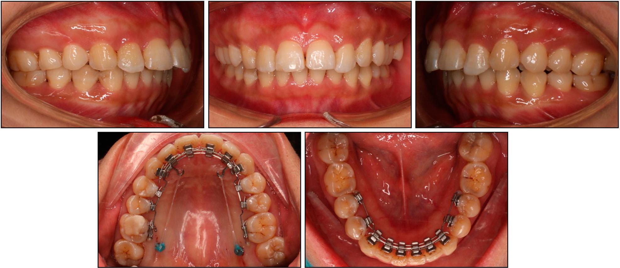 Entire upper arch distalisation using mini-screws, crimpable hooks, and power chains.