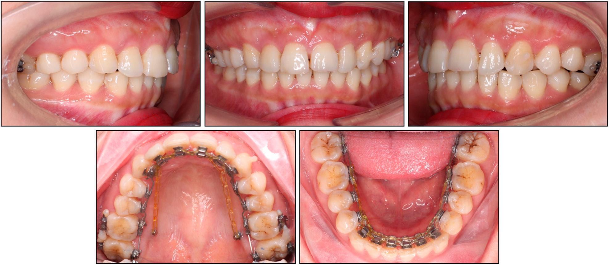 Re-levelling stage after bonding the upper second molar brackets.
