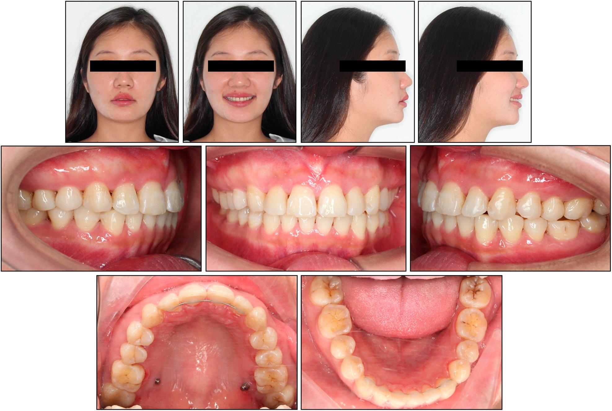 Case 2: post-treatment extraoral and intraoral photographs.