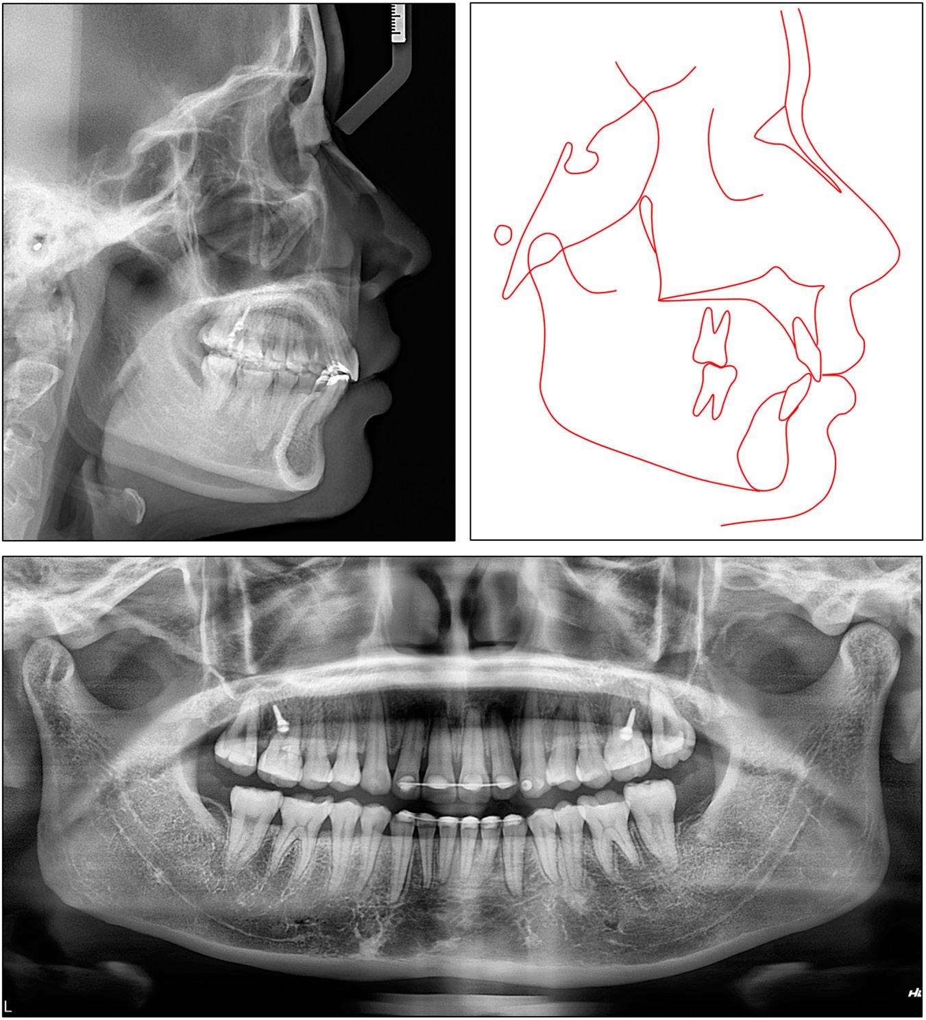 Case 2: post-treatment panoramic and cephalometric radiographs and tracing.