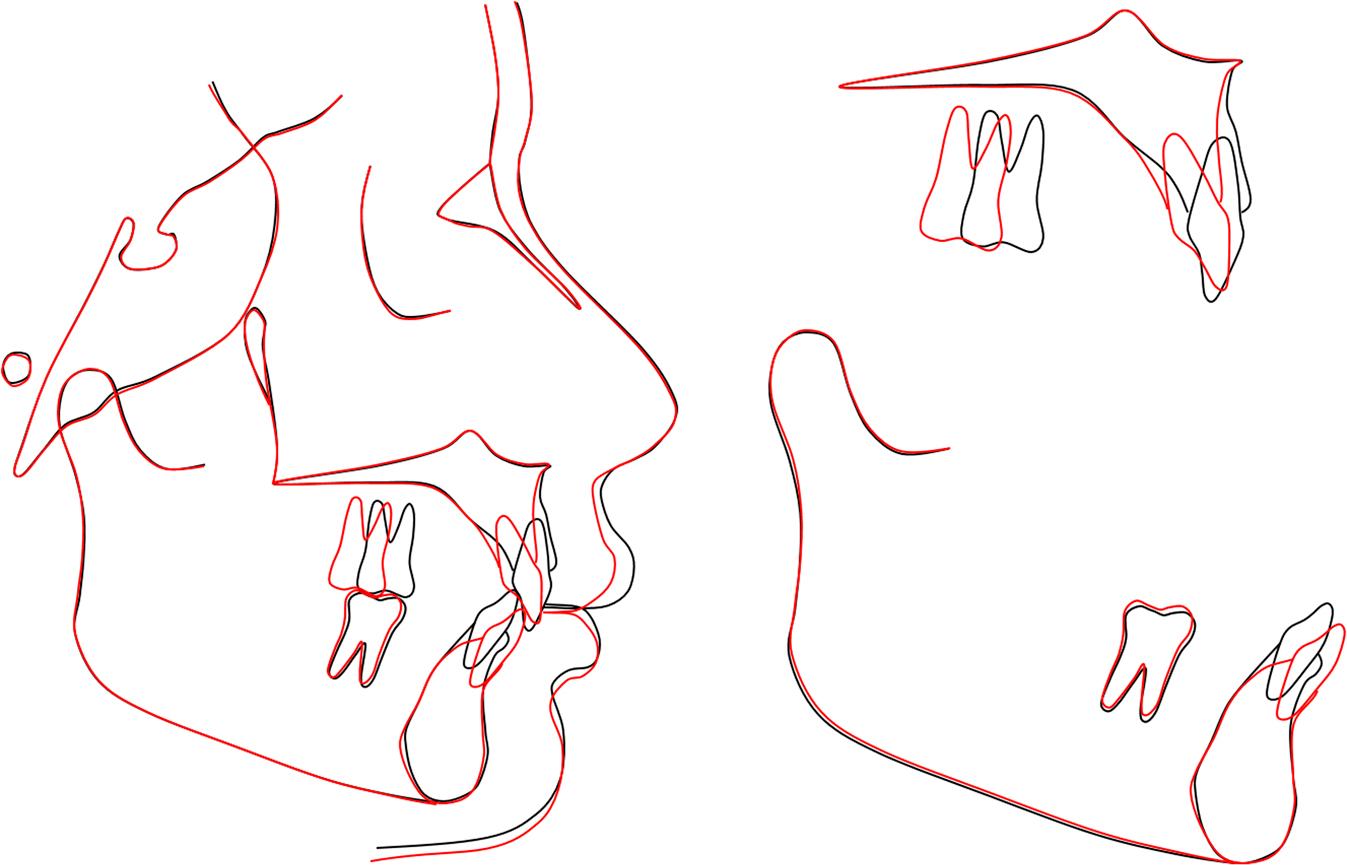 Case 2: general and regional superimpositions of pretreatment and post-treatment cephalometric tracings.