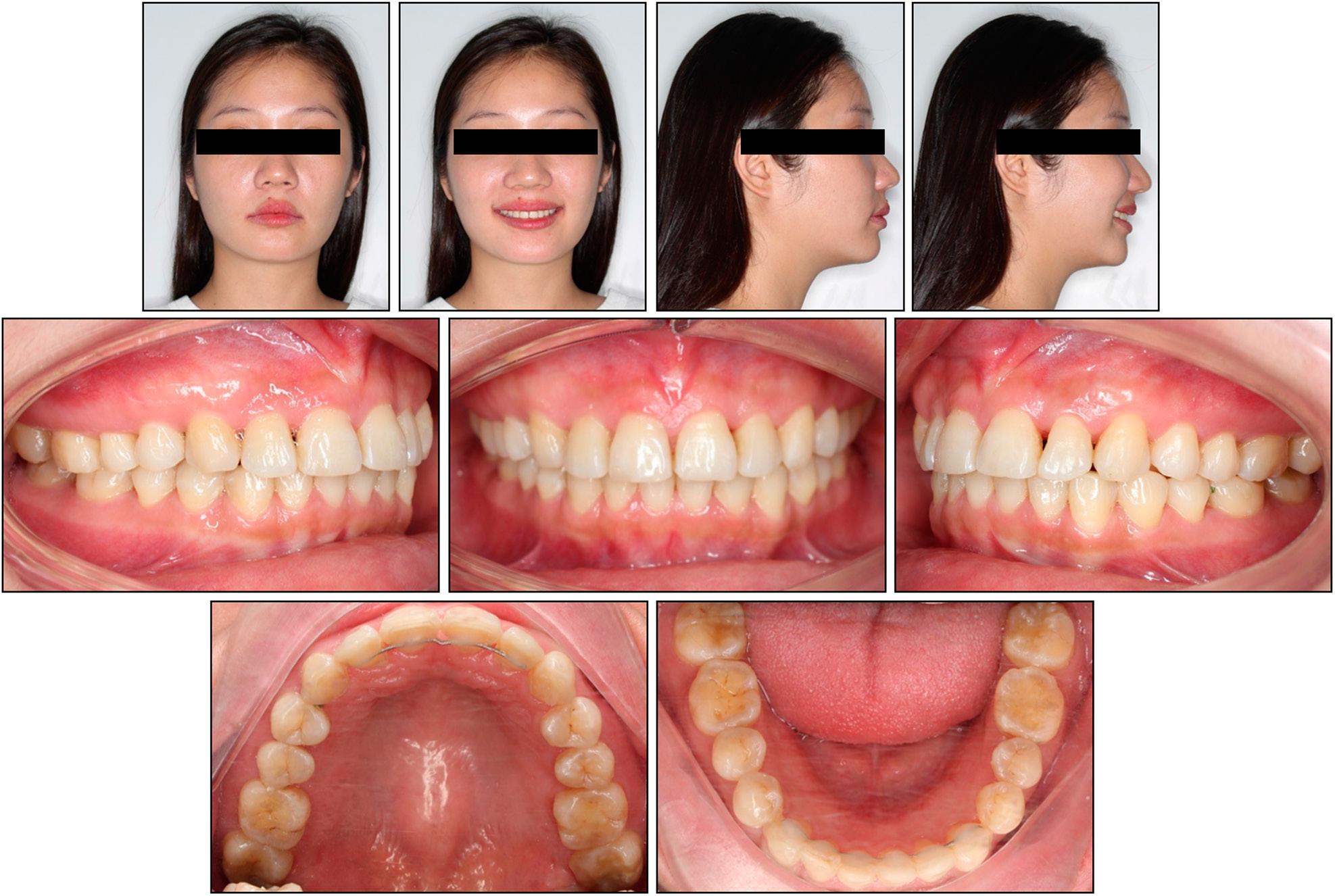 Case 2: one-year post-retention extraoral and intraoral photographs.