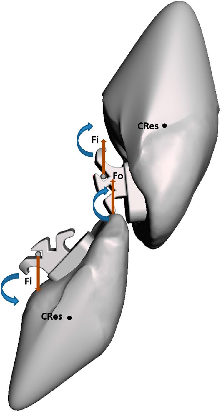Counter-clockwise moments created by the arch wire intrusion force and occlusal force make the upper incisor further retroclined. Fi: intrusion forces applied by arch wires. Fo: occlusal forces applied by lower incisors.