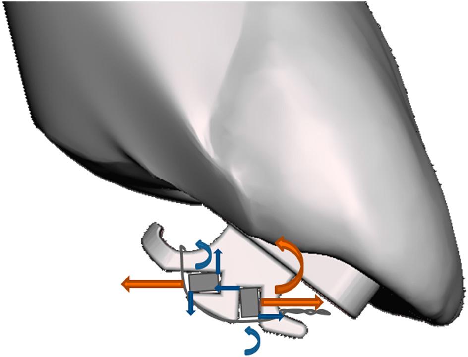 Torque control using the double-slotted bracket. Blue arrows: couples generated by rectangular arch wires. Orange arrows: couples generated by relative positions of the two arch wires.