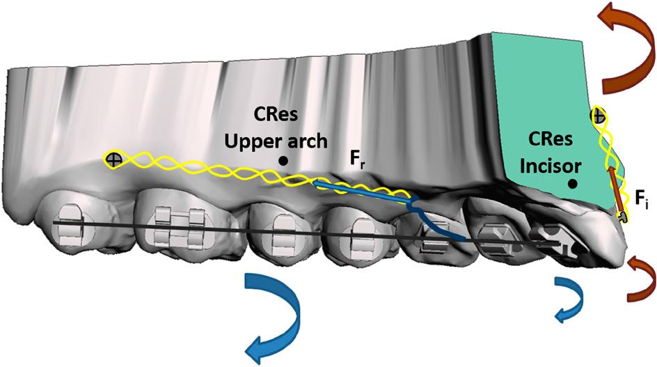 An incisor intrusion force (Fi) generates counter-clockwise moments (orange arrows) to increase incisor torque and counteract the clockwise moment (blue arrows) created by the entire arch retraction force (Fr).