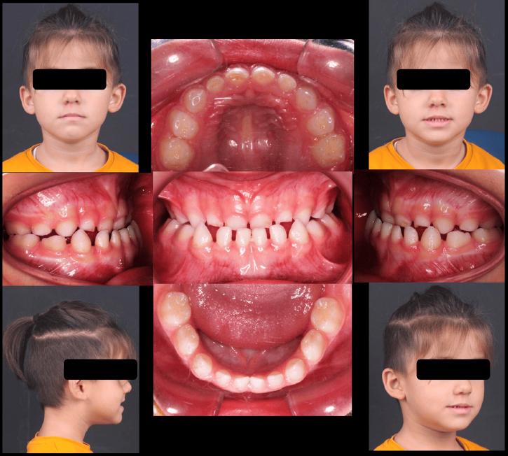 Pre-treatment intra- and extra-oral records of a 5-year-old patient.