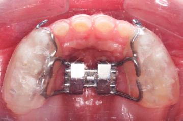 Acrylic Cap Splint Rapid Maxillary Expansion Appliance.