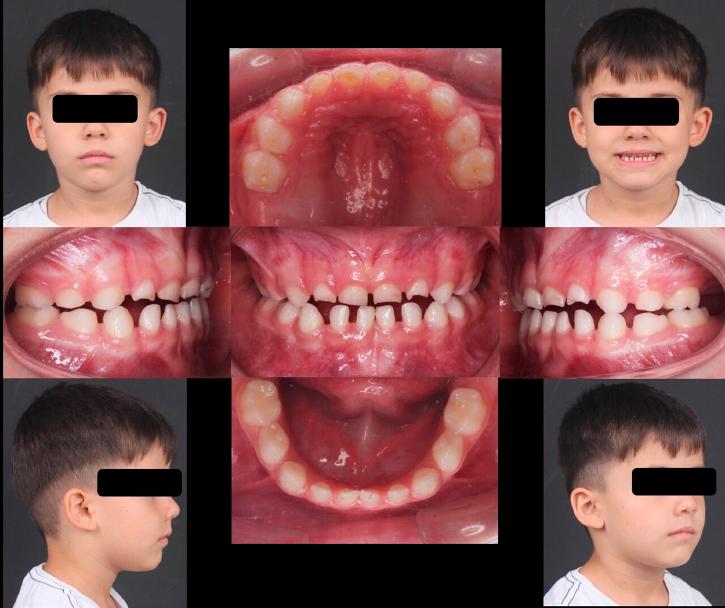 intra- and extra-oral records of the same patient after face mask therapy, prior to the removal of the rapid maxillary expansion appliance.