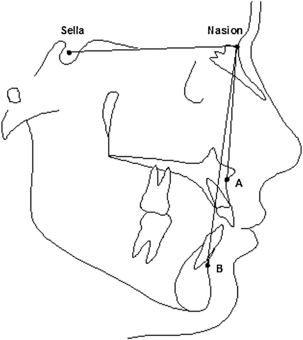 Subspinale (A), Nasion (N), Supramentale (B) and the ANB angle was used to classify the sagittal skeletal relationship as follows: Class I (1°< ANB <4°), Class II (ANB >4°), and Class III (ANB <1°).