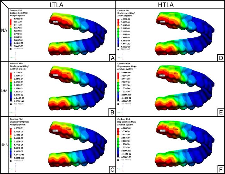 Clear aligner deformation. (A) Low and flat trimline aligner, and no attachment; (B) Low and flat trimline aligner, and 3 mm horizontal rectangular attachment; (C) Low and flat trimline aligner, and 4 mm horizontal rectangular attachment; (D) High and flat trimline aligner, and no attachment; (E) High and flat trimline aligner, and 3 mm horizontal rectangular attachment; (F) High and flat trimline aligner, and 4 mm horizontal rectangular attachment.