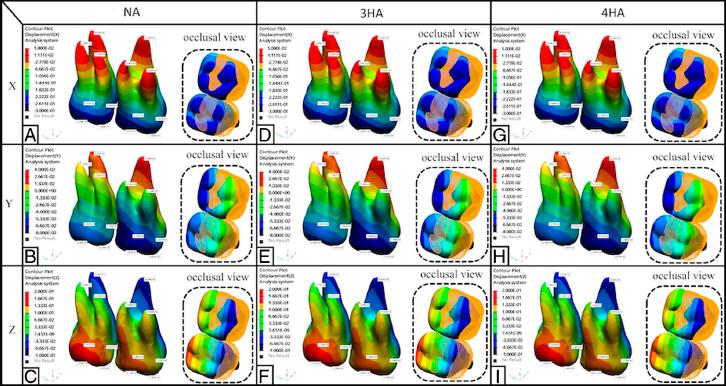 Three-dimensional displacement tendency of the maxillary first and second molars in low and flat trimline aligner (LTLA) models. No attachment: (A) Displacement along the x-axis; (B) Displacement along the y-axis; (C) Displacement along the z-axis; 3 mm horizontal rectangular attachment: (D) Displacement along the x-axis; (E) Displacement along the y-axis; (F) Displacement along the z-axis; 3 mm horizontal rectangular attachment: (G) Displacement along the x-axis; (H) Displacement along the y-axis; (I) Displacement along the z-axis.
